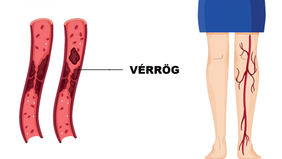 A vérrög 10 korai figyelmeztető jele, amit soha nem szabad figyelmen kívül hagyni